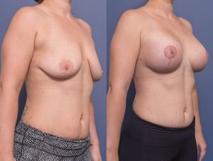 breast augmentation (and lift) before and after - patient 010 - 45 degree view