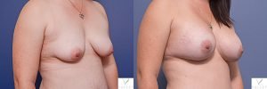 breast augmentation surgery before and after - image 002 - patient 015 - 45 degree view