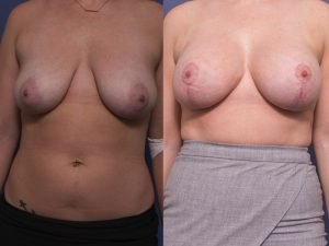 breast augmentation gallery - before & afters - patient 005A - front view