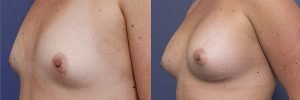oblique breast augmentation before and after gallery - patient 009