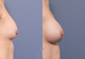 MP side remove and replace implants - Breast Augmentation Brisbane 18